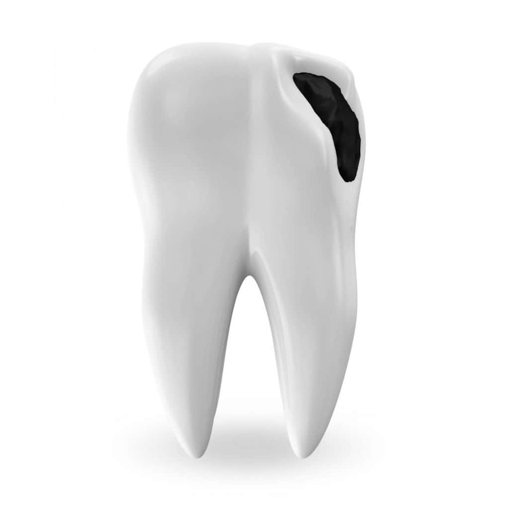 一顆帶有黑色蛀洞的3D渲染牙齒，用於牙科教育。