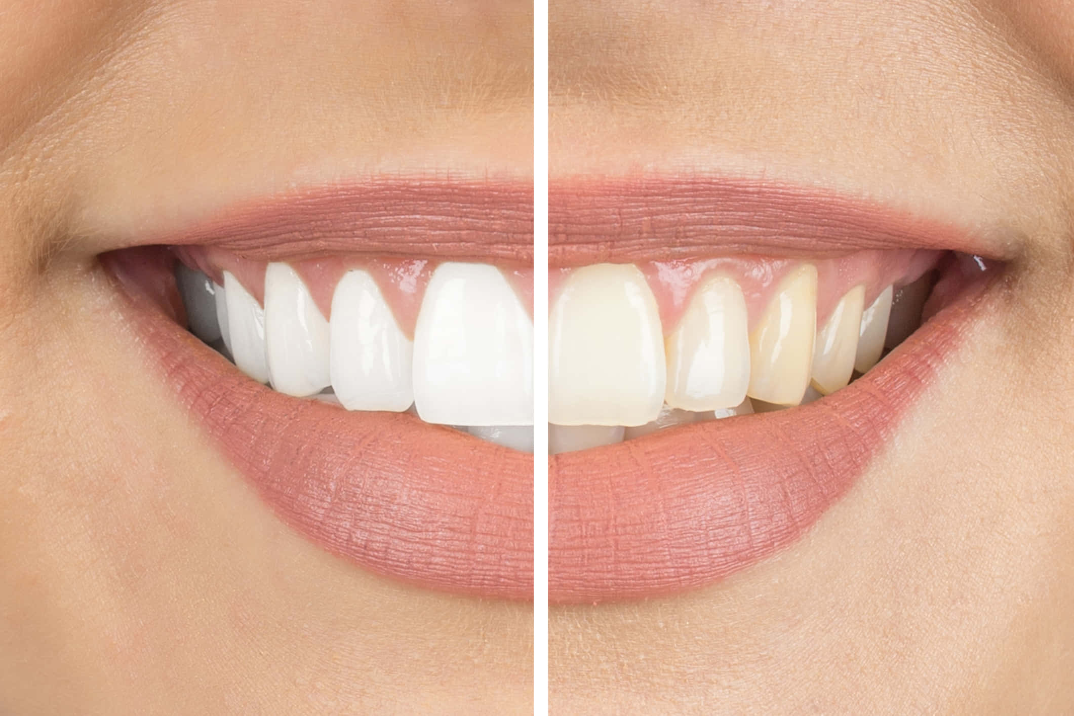 Teeth Whitening 桌布 壁紙 — 人物微笑嘅分割畫面近鏡，顯示牙齒美白治療前後對比。