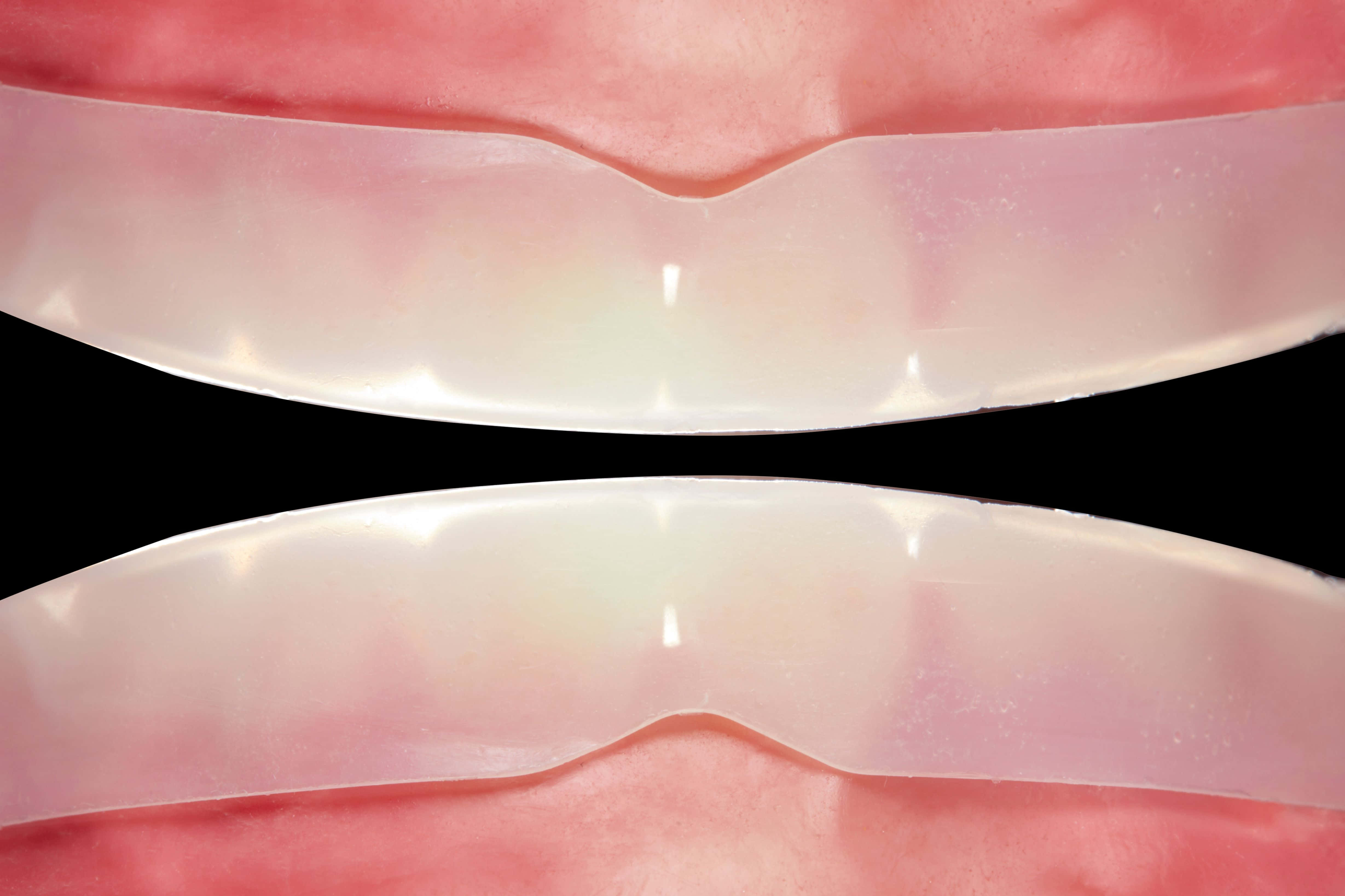 Teeth Whitening 桌布 壁紙 — 兩個半透明牙齒矯正器特寫，放在粉紅色牙齦上，黑色背景。