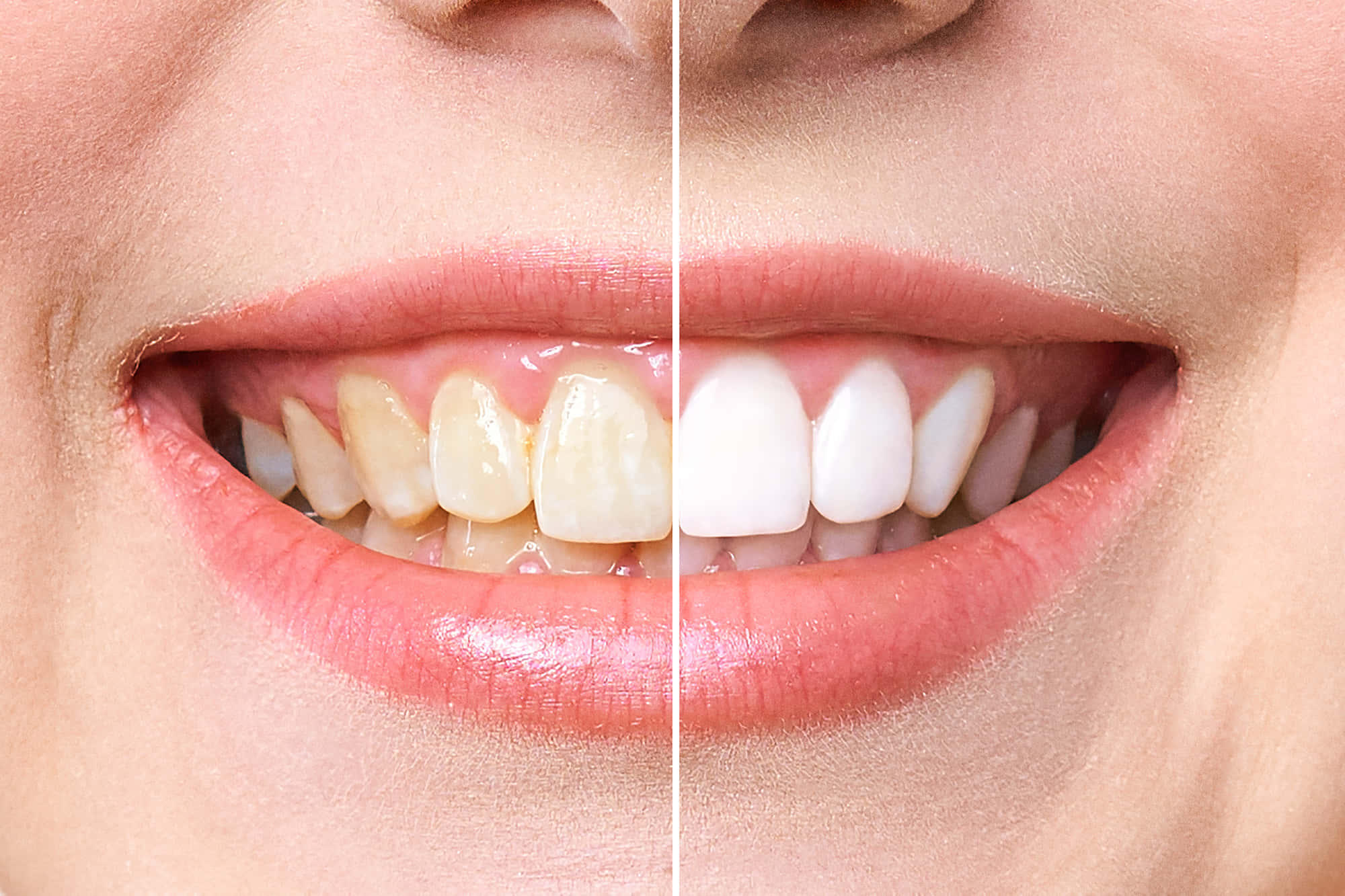 Teeth Whitening 桌布 壁紙 — 分開視圖顯示一個人的微笑，黃牙轉變為亮白，呈現牙齒美白效果。