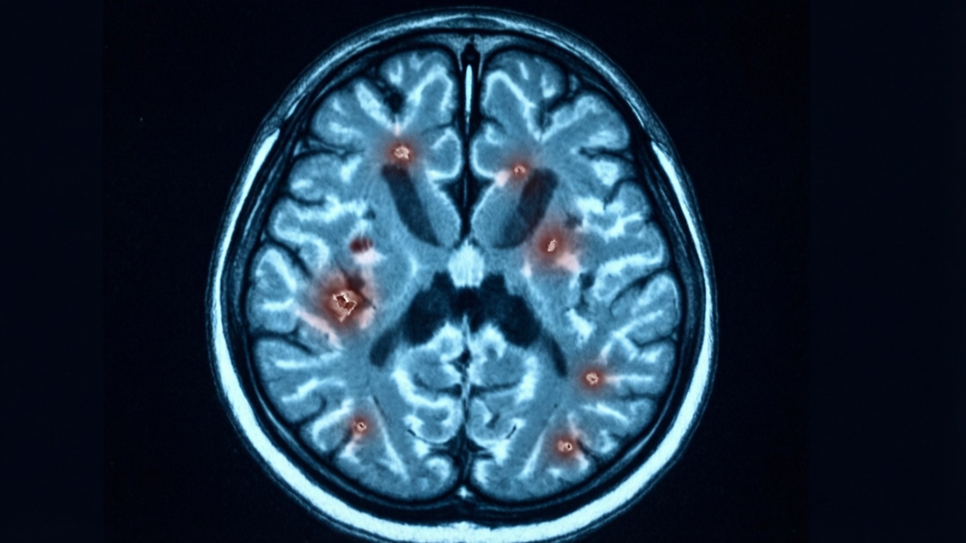 多發性硬化症腦部MRI影像 壁紙 — 人腦軸向MRI掃描，顯示多個明亮的紅色病變，背景為藍灰色神經組織。