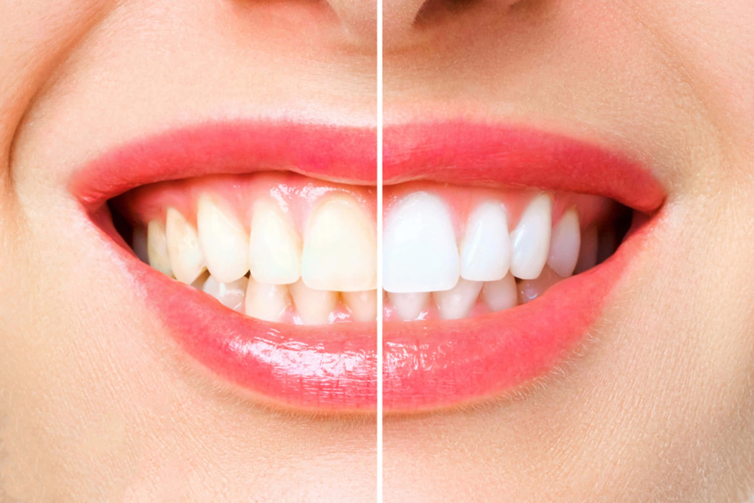 Teeth Whitening 桌布 壁紙 — 微笑嘴巴的分割視圖，顯示牙齒美白前後的轉變。
