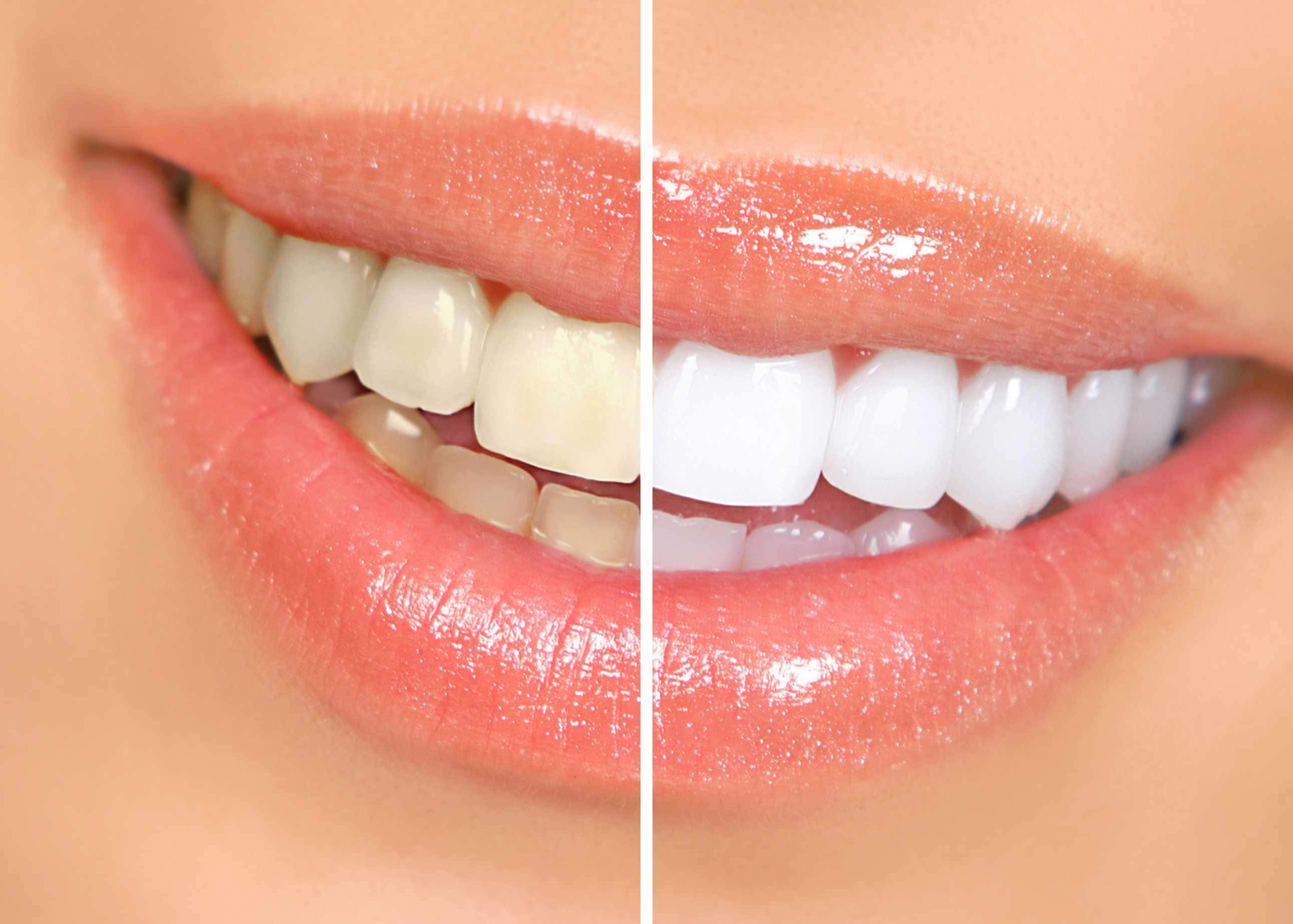 Teeth Whitening 桌布 壁紙 — 微笑嘴巴的分割視圖，顯示美白治療前後的黃牙和亮白牙齒。