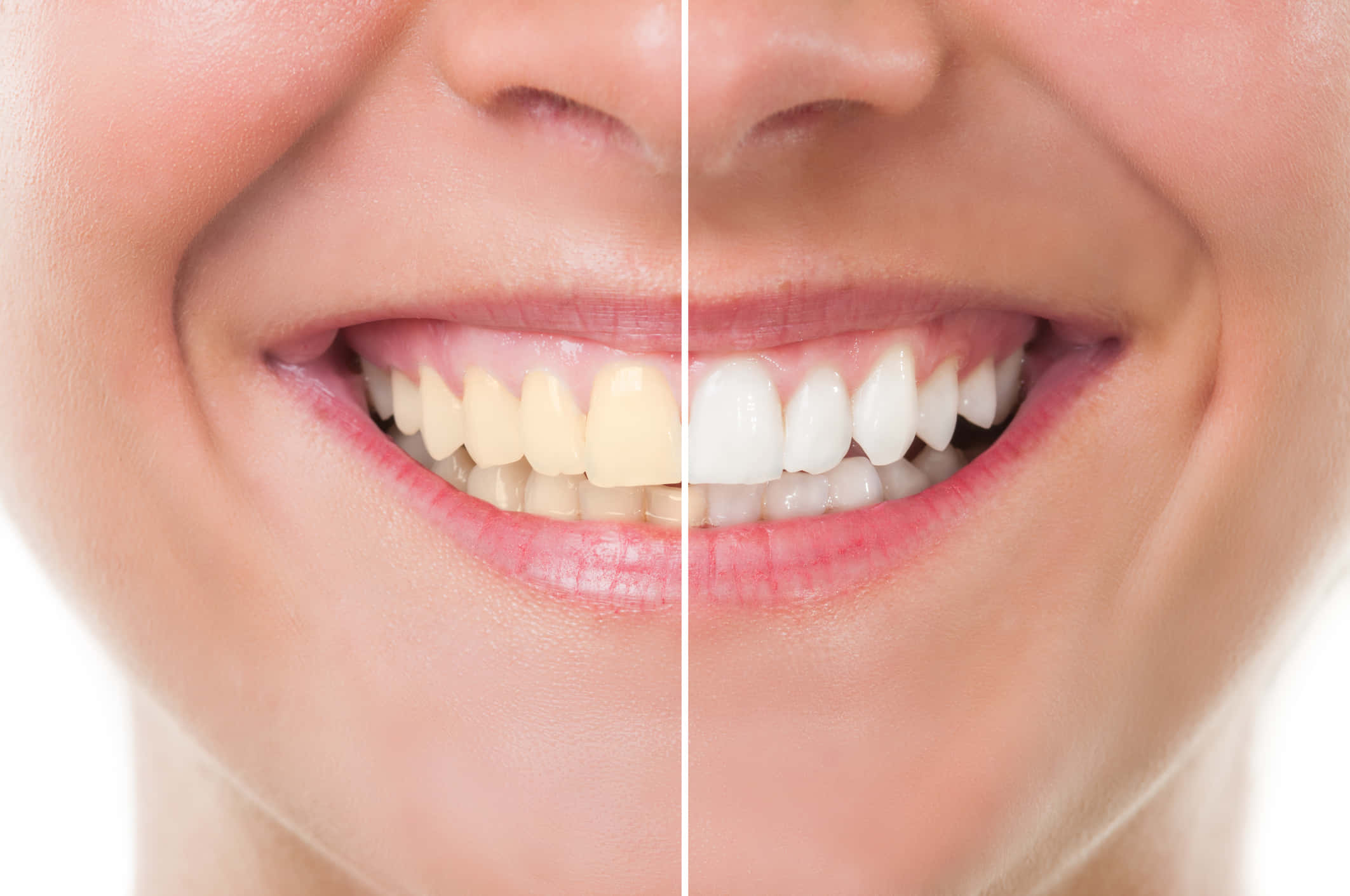 Teeth Whitening 桌布 壁紙 — 微笑嘴巴的分割視圖，顯示黃色牙齒轉變為亮白色以達到牙齒美白效果。