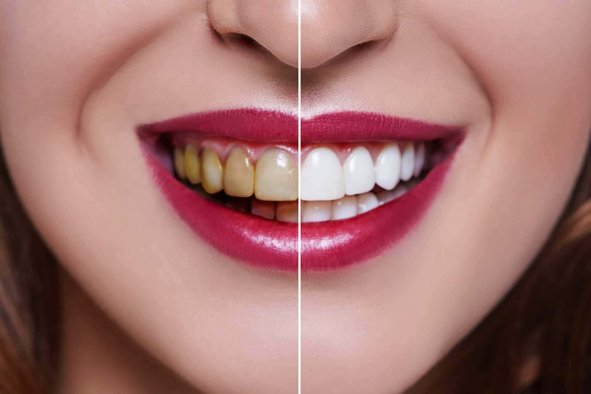 Teeth Whitening 桌布 壁紙 — 微笑女性的嘴巴分割視圖，一側顯示黃色牙齒，另一側顯示亮白色牙齒。