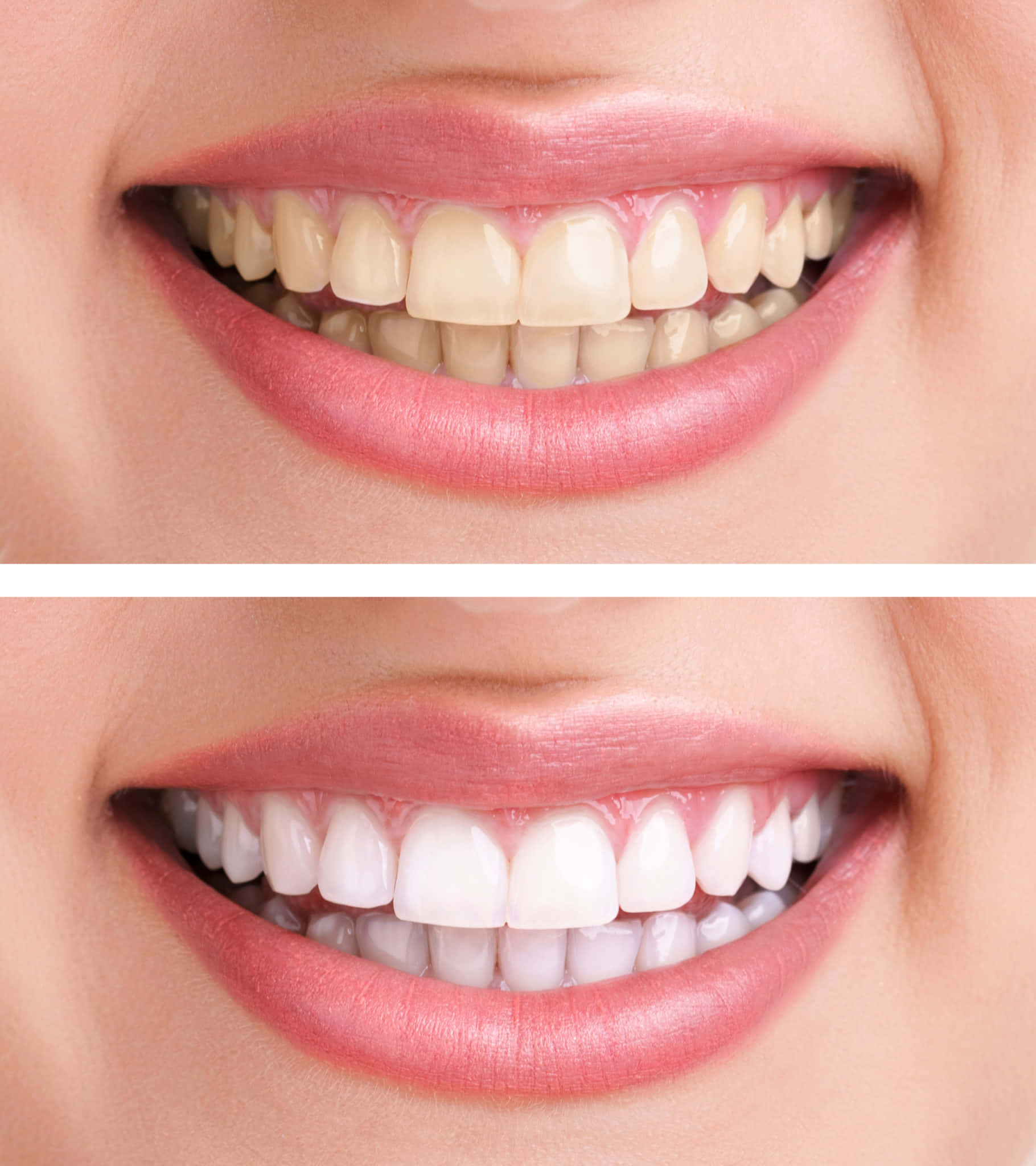 Teeth Whitening 桌布 壁紙 — 牙齒美白前後對比，展現明亮笑容轉變，搭配自然嘴唇和潔淨牙齒。
