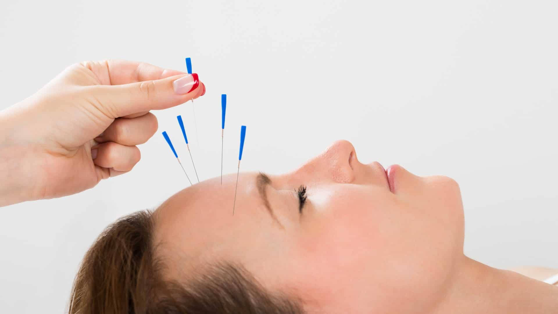 一位躺著的女性接受針灸治療，額頭上有針。