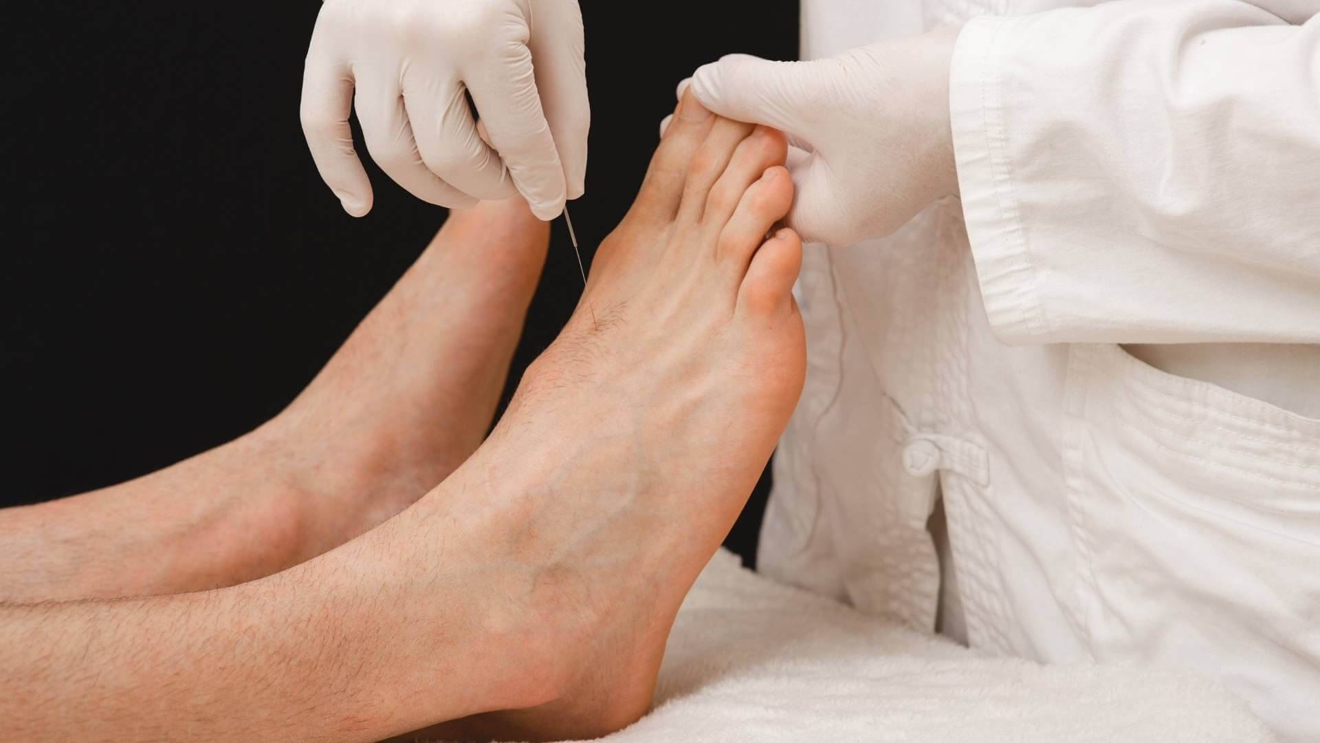 治療師戴著手套為病人的腳進行針灸。