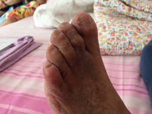 一位長者乾裂的腳部在粉紅色條紋床單上。