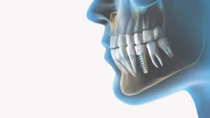 人類下顎近鏡，有牙科植體螺絲。 — 甜牙 GIF 壁紙